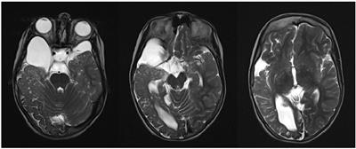 Case Report: A Case of Glioblastoma in a Patient With Haberland Syndrome